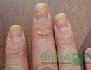 Traitement des vides sous les ongles Ampoule sous l'ongle