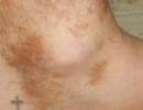 Skin manifestations of diabetes mellitus - may be the first symptoms of the disease Skin diseases of type 2 diabetes