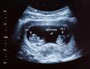 Condition of the woman and fetus in the eighth week of pregnancy