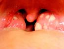 Tipi di mal di gola nei bambini e metodi di trattamento