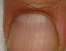 Diagnostika nehtů na rukou a nohou