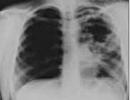 Tuberkuliozė ir nėštumas: nėštumas po tuberkuliozės, tuberkuliozė nėštumo metu, tuberkuliozės poveikis nėštumui